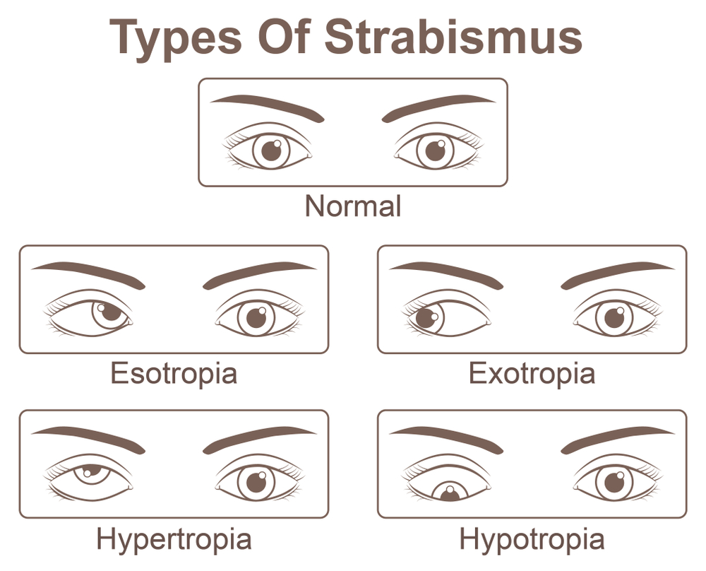 Strabismus types